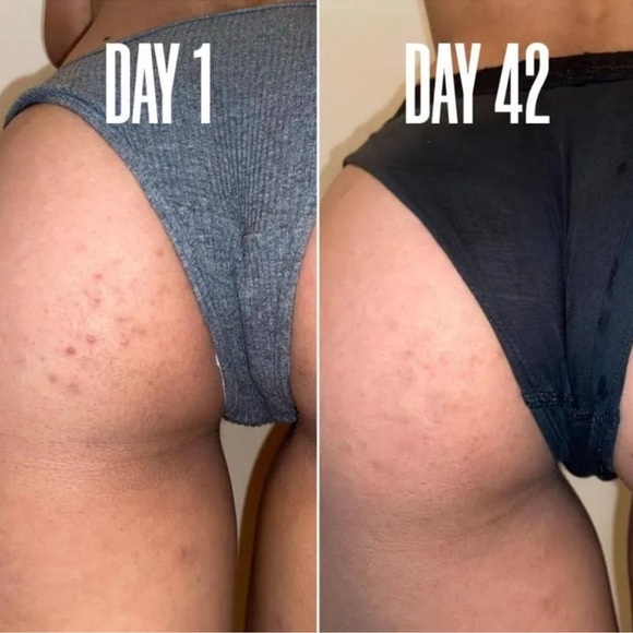 MAELYS B-Lucid Targeted Body Acne Gel 3.38oz NIB Sealed $49 NIB Sealed - Picture 6 of 16